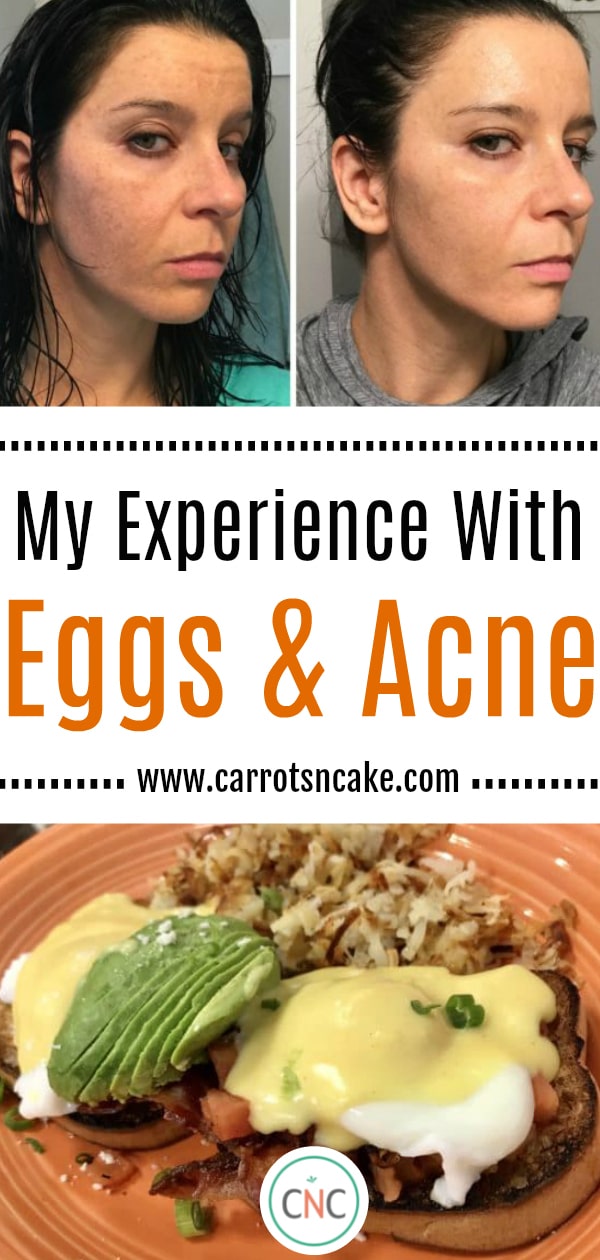 My experience with eggs & acne; www.carrotsncake.com; Two side-by-side photos of the same female face comparing acne; photo of eggs benedict breakfast with avocado 